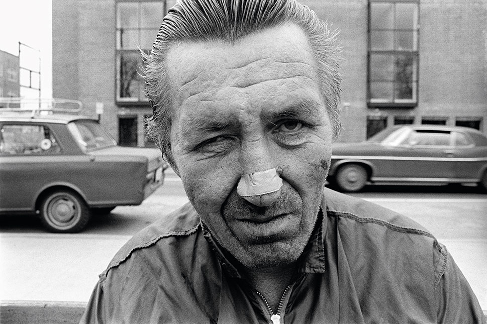 Man With Bandaged Nose – 1974