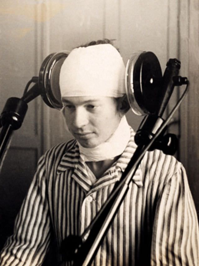 Egy olyan beteg, aki az 1920-as évek elején oldalsó agyi diatermiás kezelésben részesült.  A diathermia horganyzott áramot használt a pszichózisban szenvedők rázására.  Az orvosok végül nem biztonságosnak és megbízhatatlannak ítélték meg.
