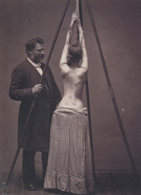 Lewis Sayre treating scoliosis, checking the curvature of the spine.