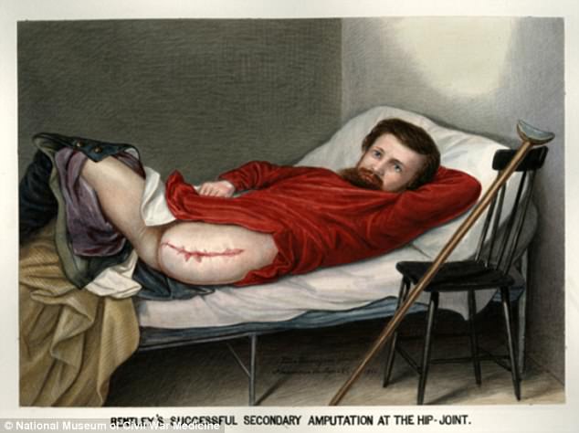 Private George W. Lemon, who was shot in the leg at the 1864 Battle of the Wilderness 1864.