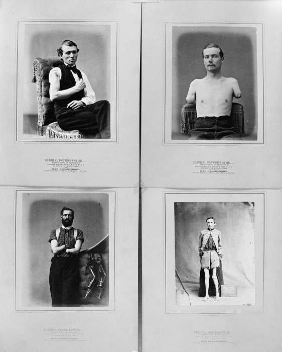 This series of photographs, compiled by the U.S. Surgeon General’s Office, illustrates the different types of arm amputations.