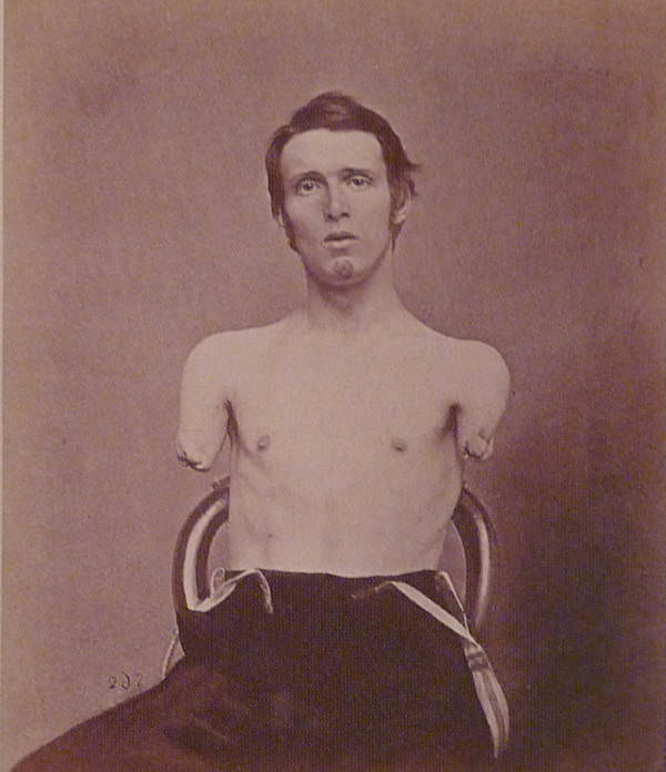 On June 18, 1864, a cannon shot took both arms of Alfred Stratton. He was just 19 years old.