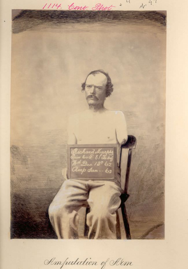 Pennsylvania infantryman Richard Murphy was wounded in December 1862. Surgeons amputated his arm shortly thereafter.