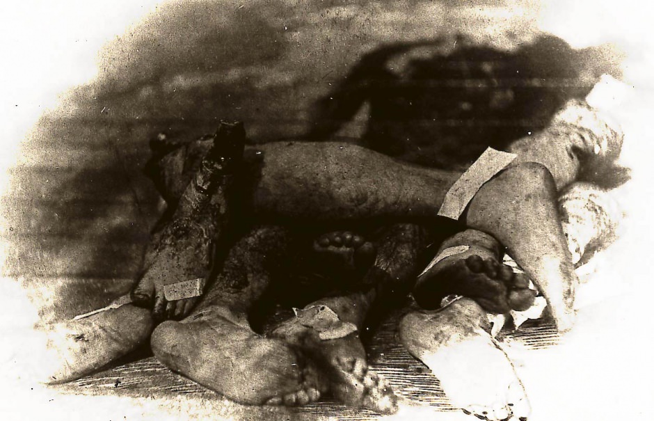 Pile of severed, amputated arms and legs in an undated photo.