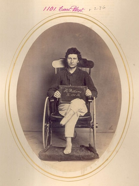 Hiram Williams. Amputation of leg and foot, shell wound. PVT, Company K, 98th Pennsylvania Volunteers. Injured at the 1865 Battle of Appomattox