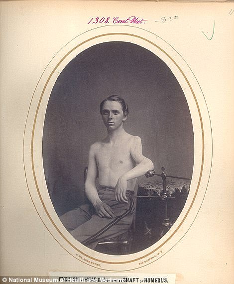 Sergeant Hector Sears from the Ohio Volunteers, was another to have six inches of his humerus removed