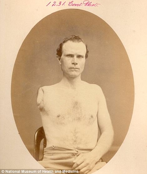 Samuel Irwin, of the 67th Pennsylvania Volunteers, had his right arm cut off at the shoulder joint