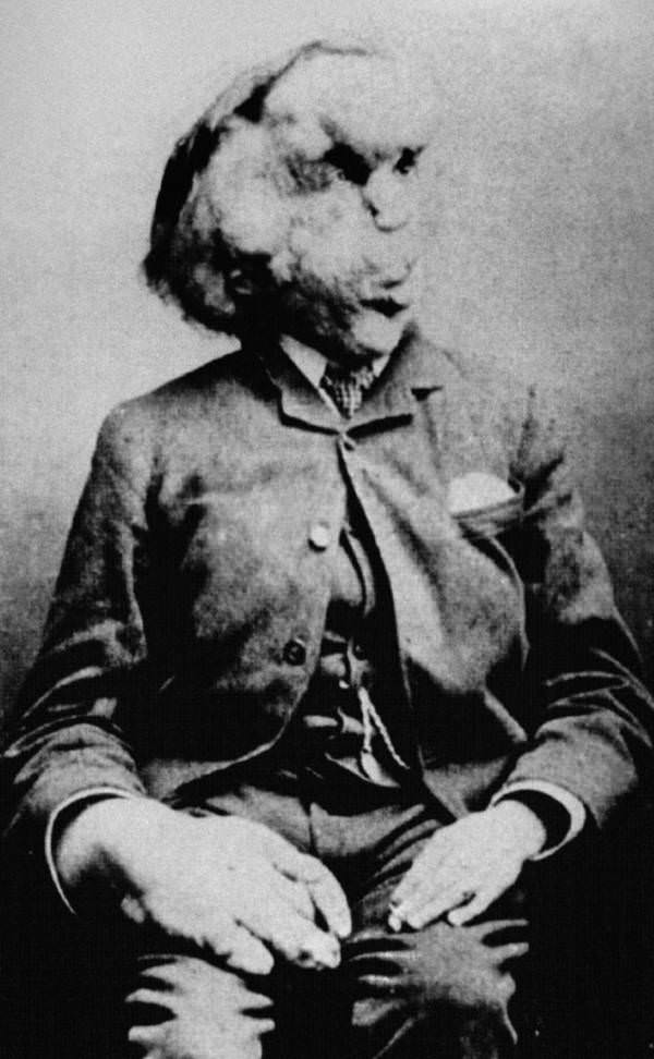 Joseph Merrick, England's famous Elephant Man, 1880s