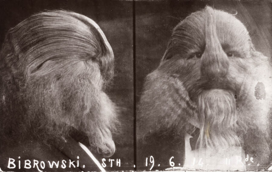 Stephan Bibrowski, better known as Lionel the "Lion-faced Man.", 1914