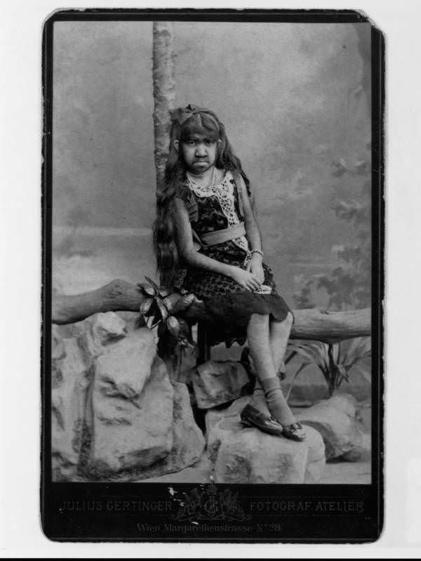 Krao Farini was a hairy, flexibly-jointed woman found in the Laotian jungle in 1885 and put on display by P.T. Barnum as a "Missing Link." 1889