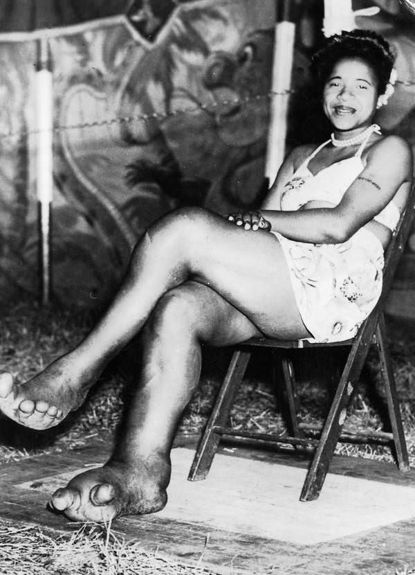 African American sideshow circus entertainer Sylvia Portis, known as Sylvia the Elephant Girl, smiling and displaying her feet, which are deformed and show signs of the disease elephantiasis, 1944