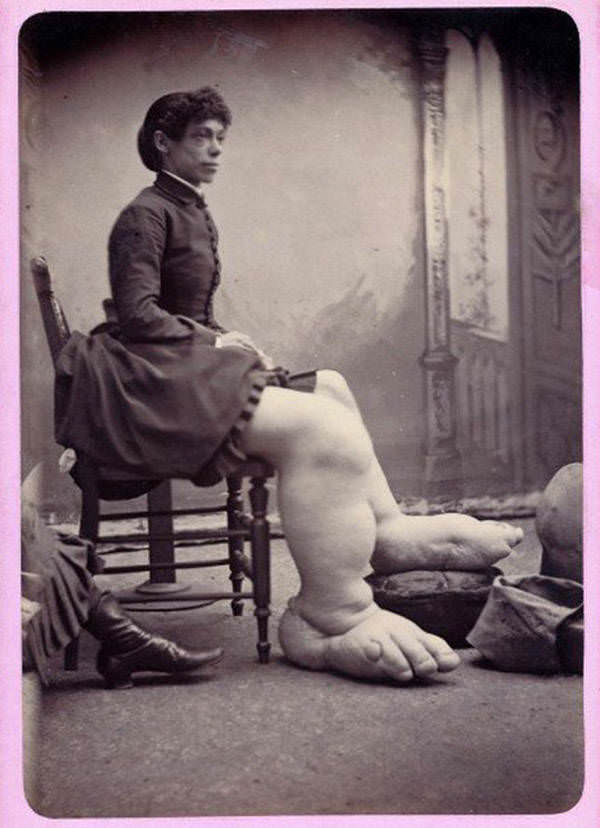 Known as “The Ohio Big Foot Girl,” Fannie Mills suffered from Milroy disease, which caused her legs and feet to become gigantic, 1890