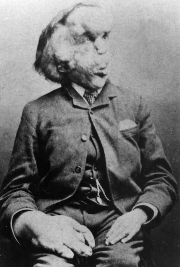 Better known as the "elephant man," Joseph Merrick lived a tragic life. Rejected by his parents, he was left to join a touring freak show act, 1889