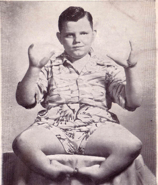 Grady Stiles Jr. a.k.a. "Lobster Boy" came from a long line of family members who suffered from the same birth defect that lent him his stage name.
