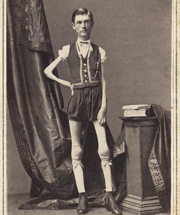 Billed as the "Living Human Skeleton," Isaac Sprague began irreversibly losing weight at age 12 for reasons that remain unclear, 1866