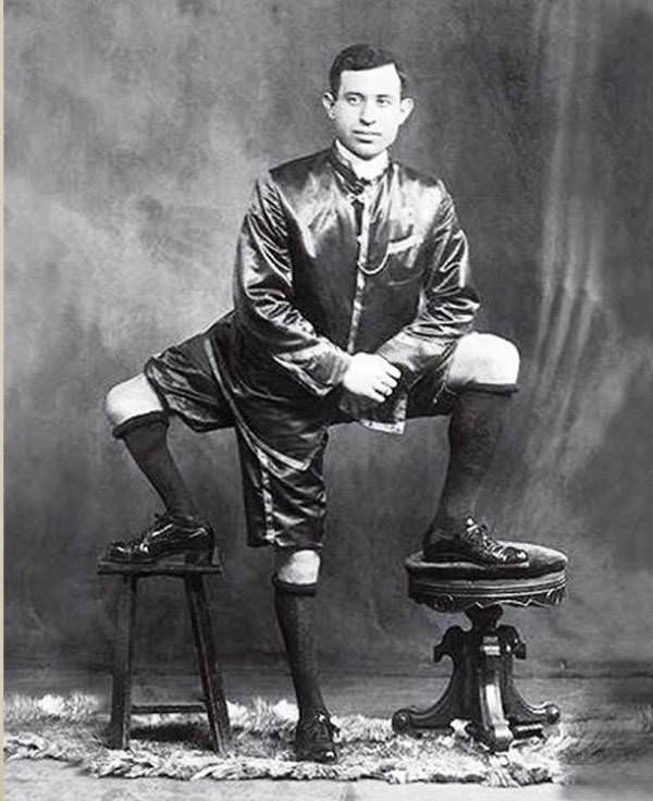 Frank Lentini was born with a parasitic twin, ultimately leaving him with a third leg, 1914