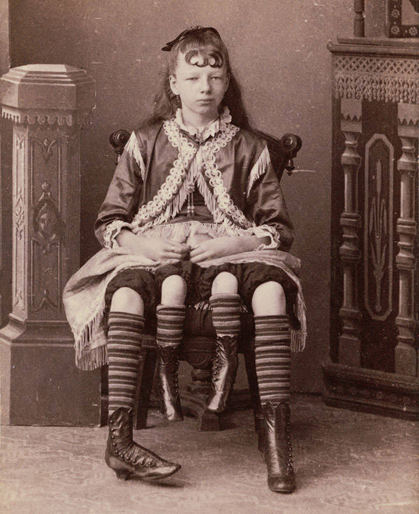 Dubbed the "Four-Legged Girl From Texas," Myrtle Corbin was born with a severe congenital deformity that caused her to have two separate pelvises and a smaller set of legs, 1882