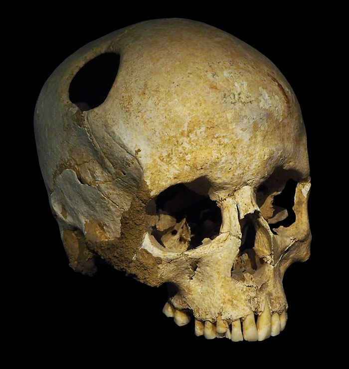 Trepanation