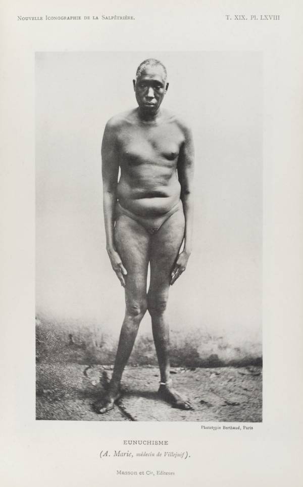 A humiliated-looking man with "eunuchism" allows scientists of the Eugenics Society to photograph him in the nude