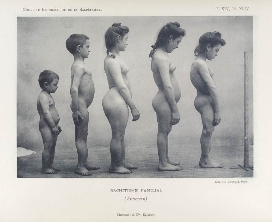 A family of children born with rickets, as photographed by the Eugenics Society, 1912