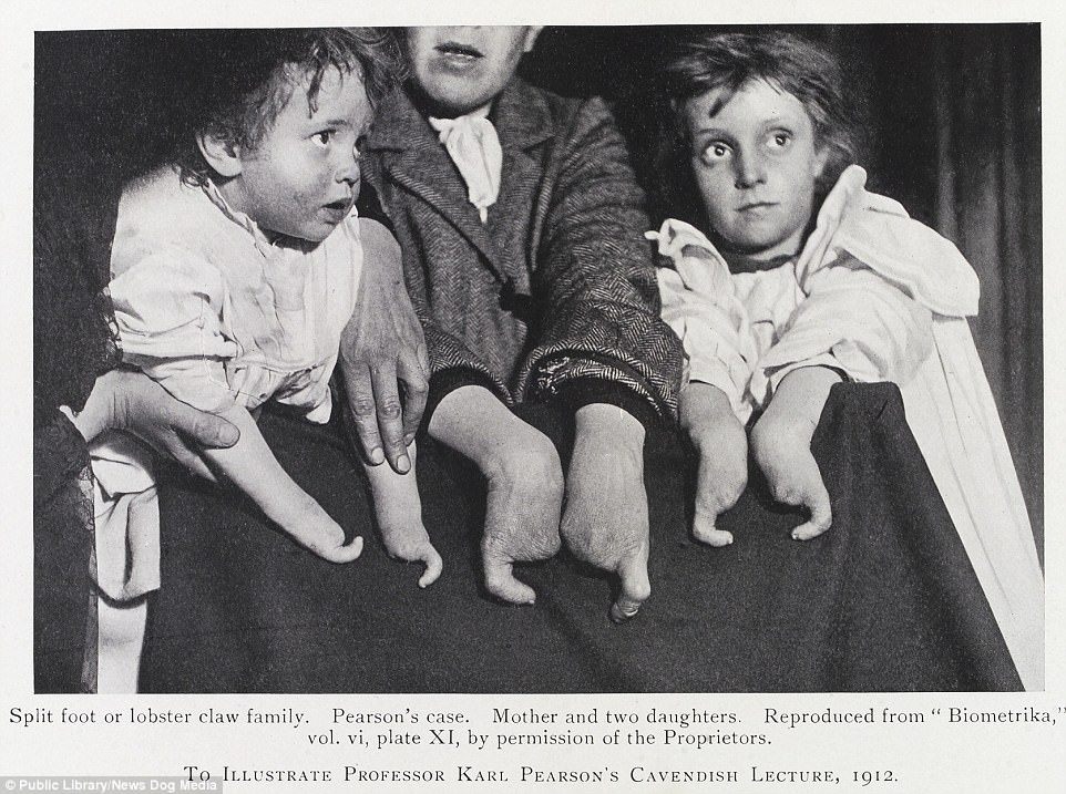 A photograph from the Eugenics Society showing a family with the "lobster claw" deformity, meant as a demonstration of a hereditary defect, 1912.