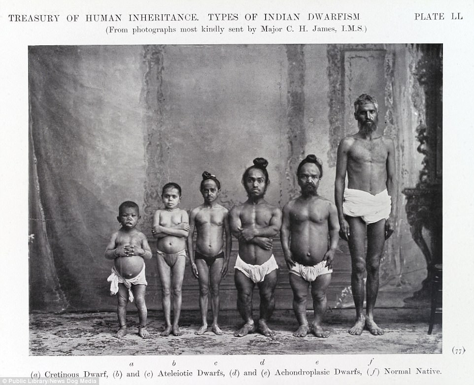 Photographs of 'Indian Dwarfism' from the Eugenics Society in 1912.