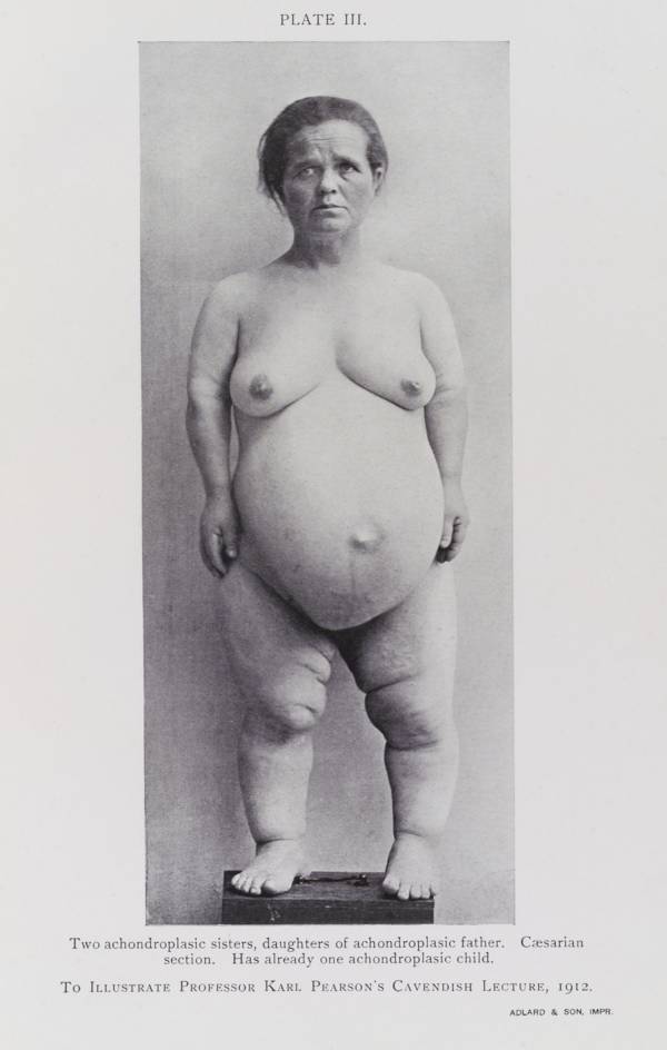 A woman with achondroplasia (a form of dwarfism), as photographed by the Eugenics Society. The notes point out that her parents and children also have achondroplasia, 1912