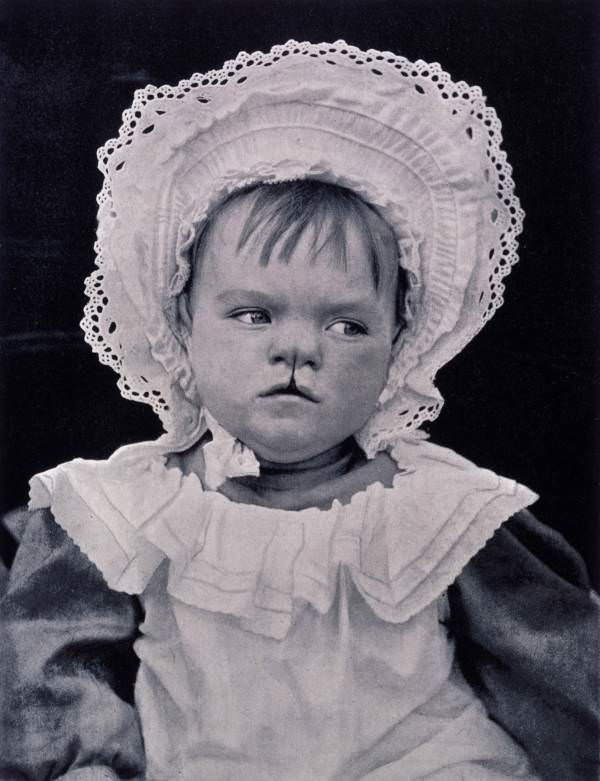 A child with a cleft lip, taken to demonstrate the type of child that should be kept from breeding, London, England. 1912.