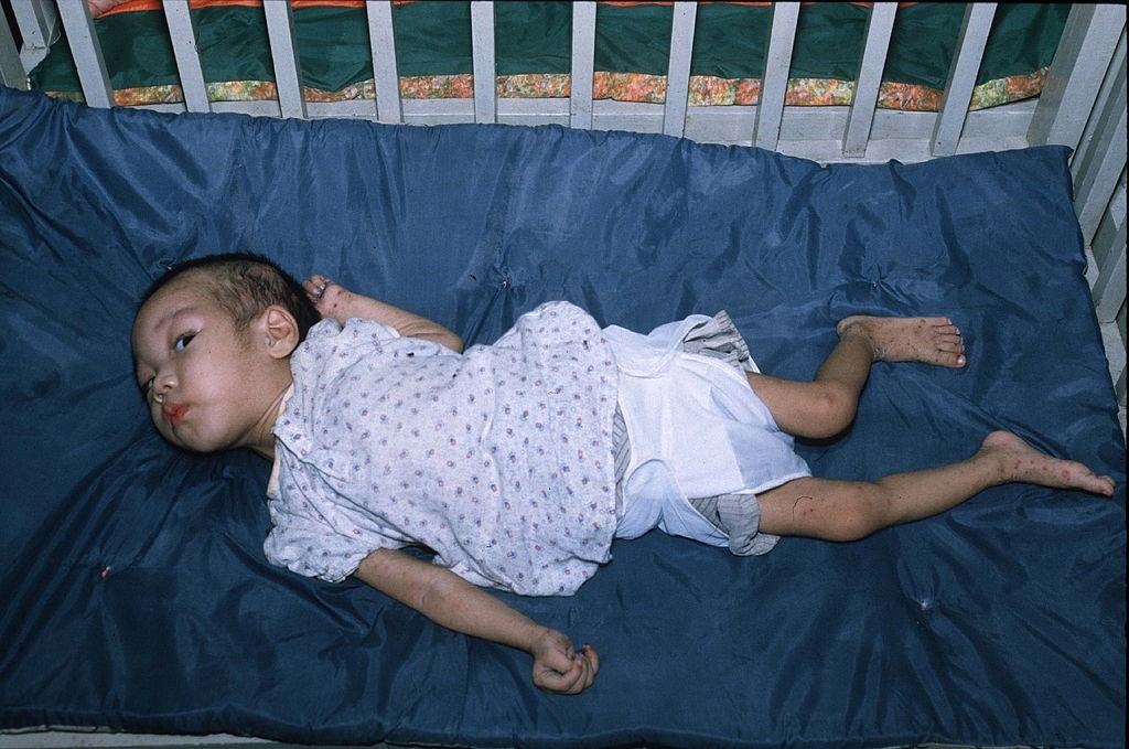 A child born with birth defects, Ho Chi Minh City, 1985