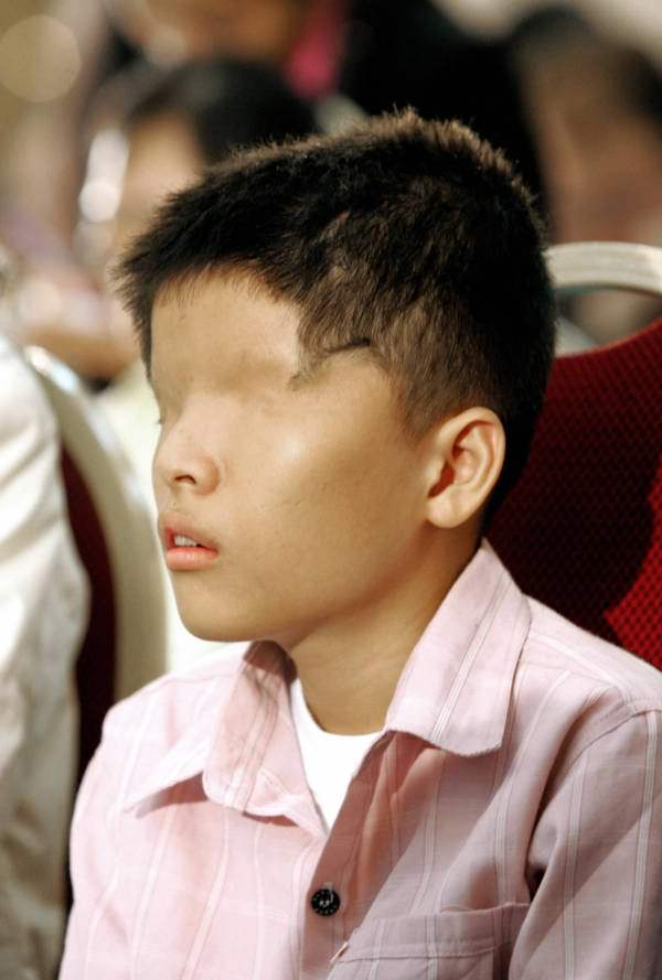 Le Van O., a 14-year-old boy who was born without eyes because of the effects of Agent Orange, Hanoi, Vietnam. March 28, 2006.