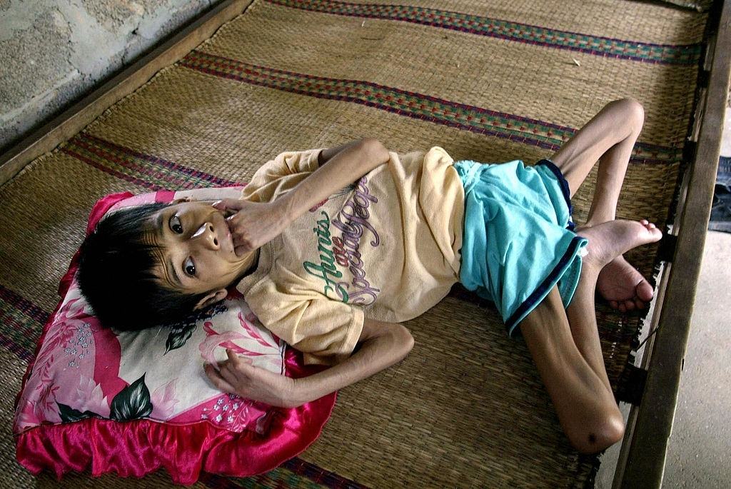 Agent Orange affected 20-year-old girl Nguyen Thi Hoa lies on a bed at her house in Nhan Loc commune, 2004