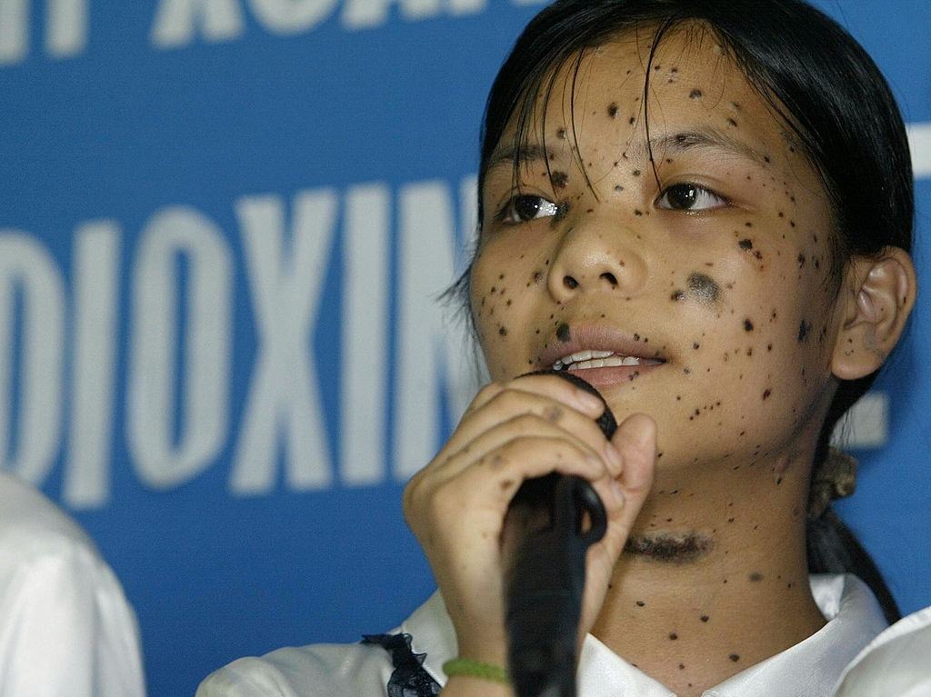 Thai Thi Nga, 15, of Hanoi's Friendship Village who is victim of agent orange sings during a ceremony held 10 August 2004