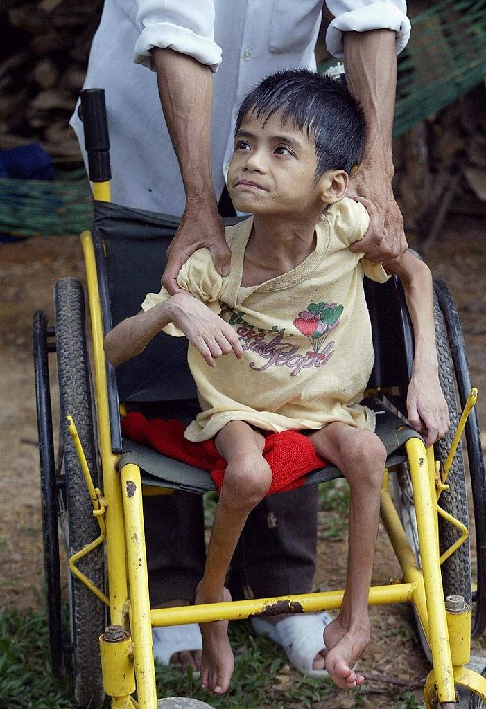Agent-orange affected 20-year-old girl Nguyen Thi Hoa is placed on a wheelchair at their home in Nhan Loc commune, 2004