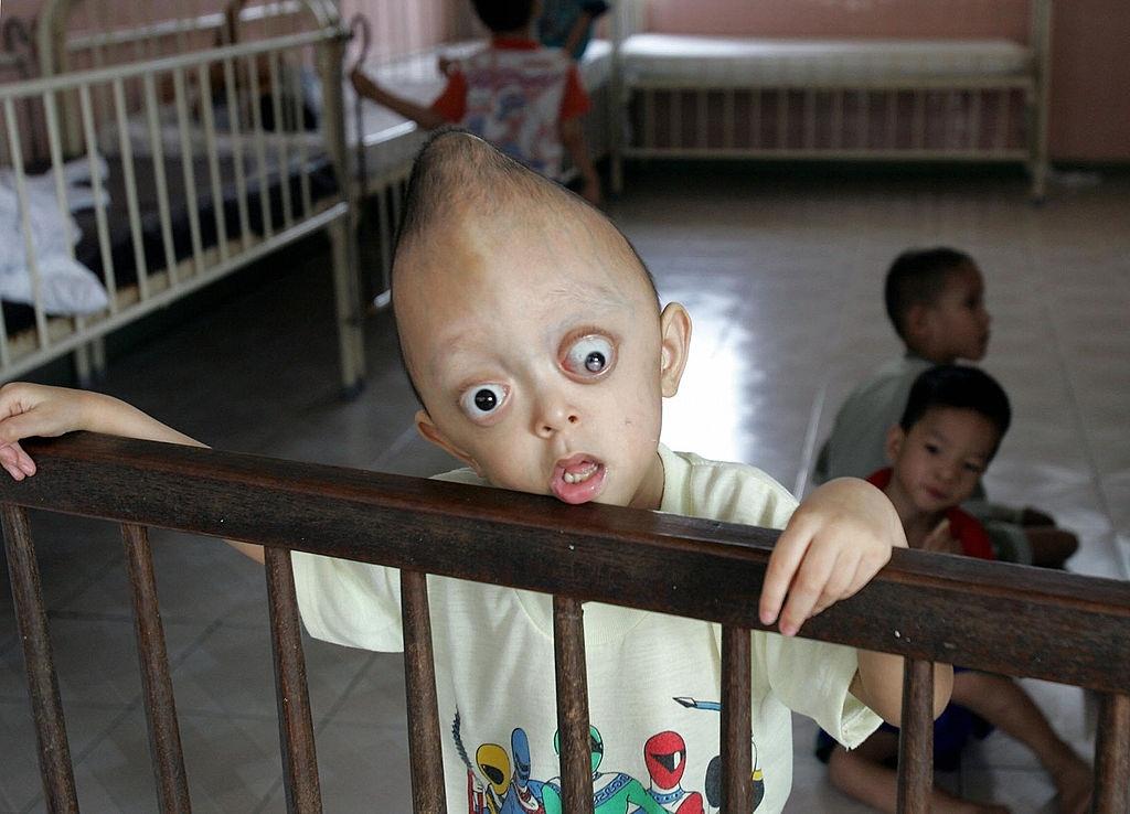 Five-year-old Agent Orange victim Xuan Minh, 2005