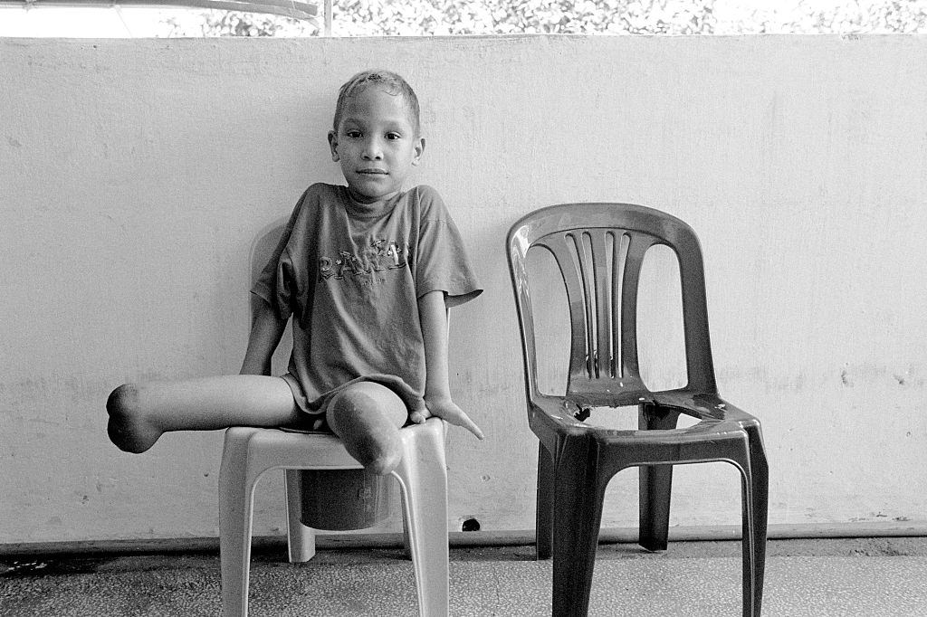 A boy with no feet sits on a chair at the Peace Village at Tu Du hospital in Ho Chi Minh City, 2004