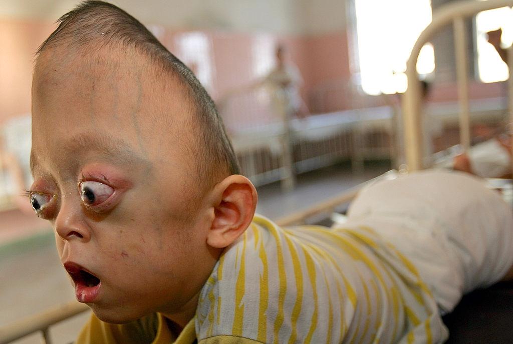 Nguyen Xuan Minh lays in a crib at the Tu Du Hospital May 2, 2005 in Ho Chi Minh City, Vietnam.