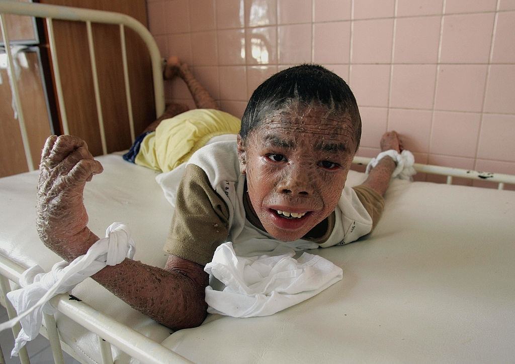 Tran Minh Anh, 11, who suffers from "fish skin" disease, from the effects of agent orange, lies on a bed with his hands tied up, at the Peace Village in Tu Du hospital,