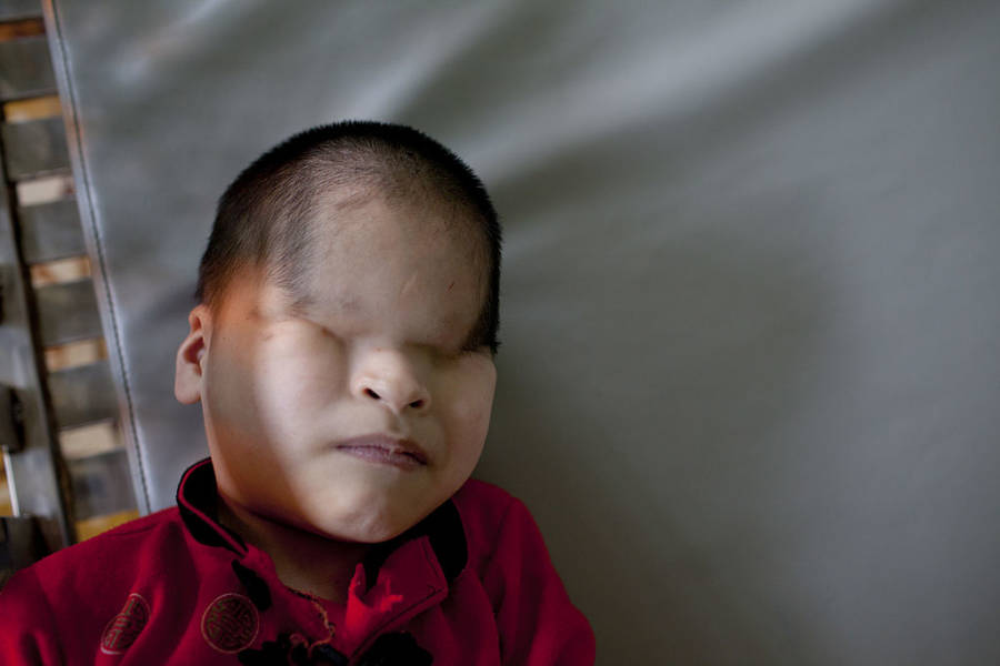 A child born without eyes lies in bed at an orphanage that takes care of 125 children, all born with disabilities because of Agent Orange, 2011