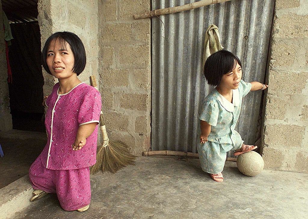 Le Thi Nhon and her younger sister Le Thi Hoa, both victims of agent orange used during the Vietnam War, 1995