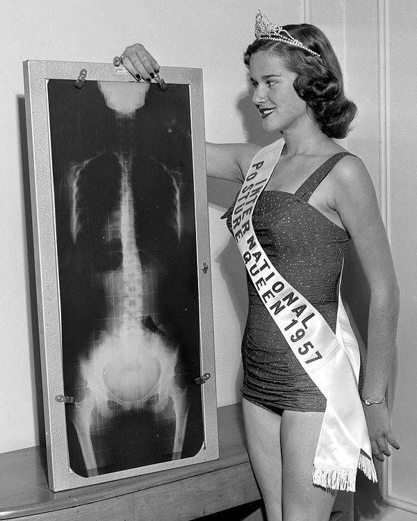 National Posture Queen Diane Stopky of St. Louis, poses next to an X-ray of her spine, New York, 1957.