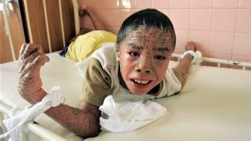 Agent Orange Victims Vietnam War