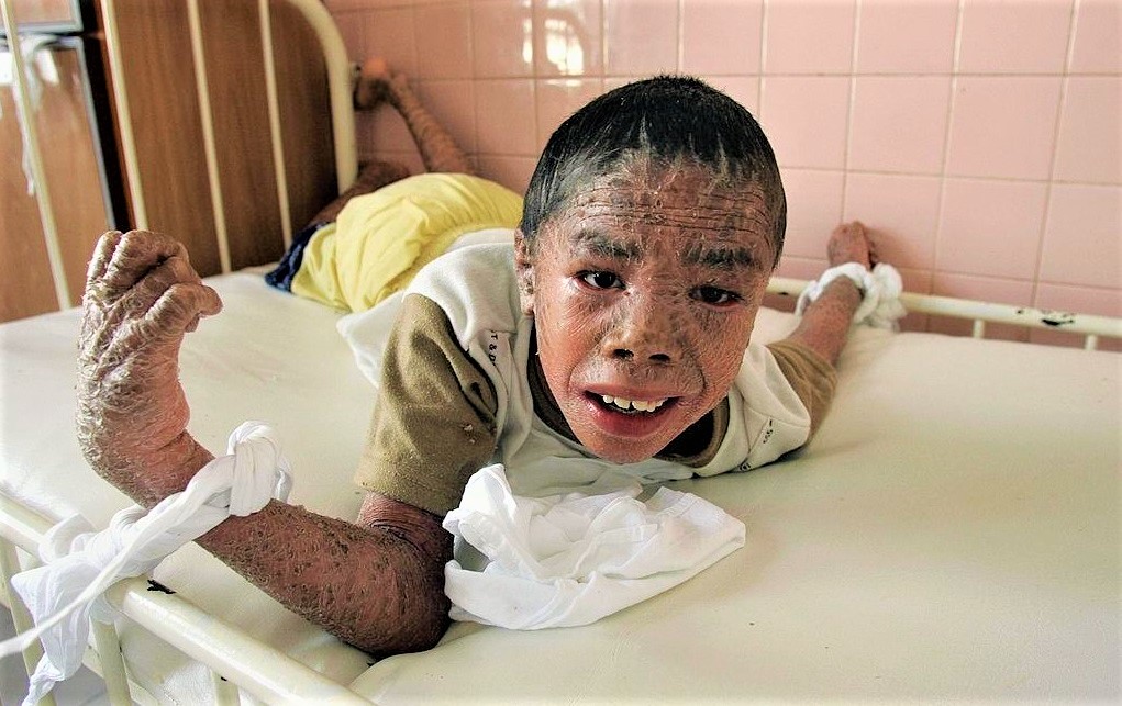 Agent Orange Victims Haunting Photos Of The Unpunished War Crimes Of U S In Vietnam War