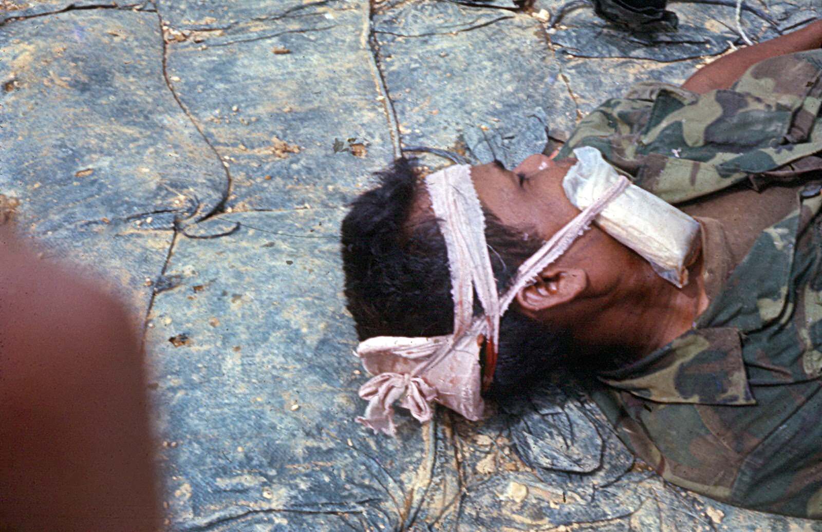 A wounded Kit Carson Scout, waiting for a helicopter medical evacuation. Vietnam. 1969.