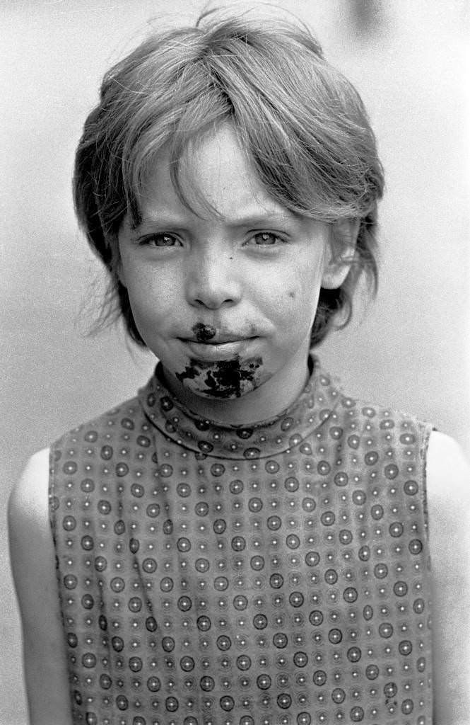 Child with Impetigo caused by foul drainage, Winson Green 1971