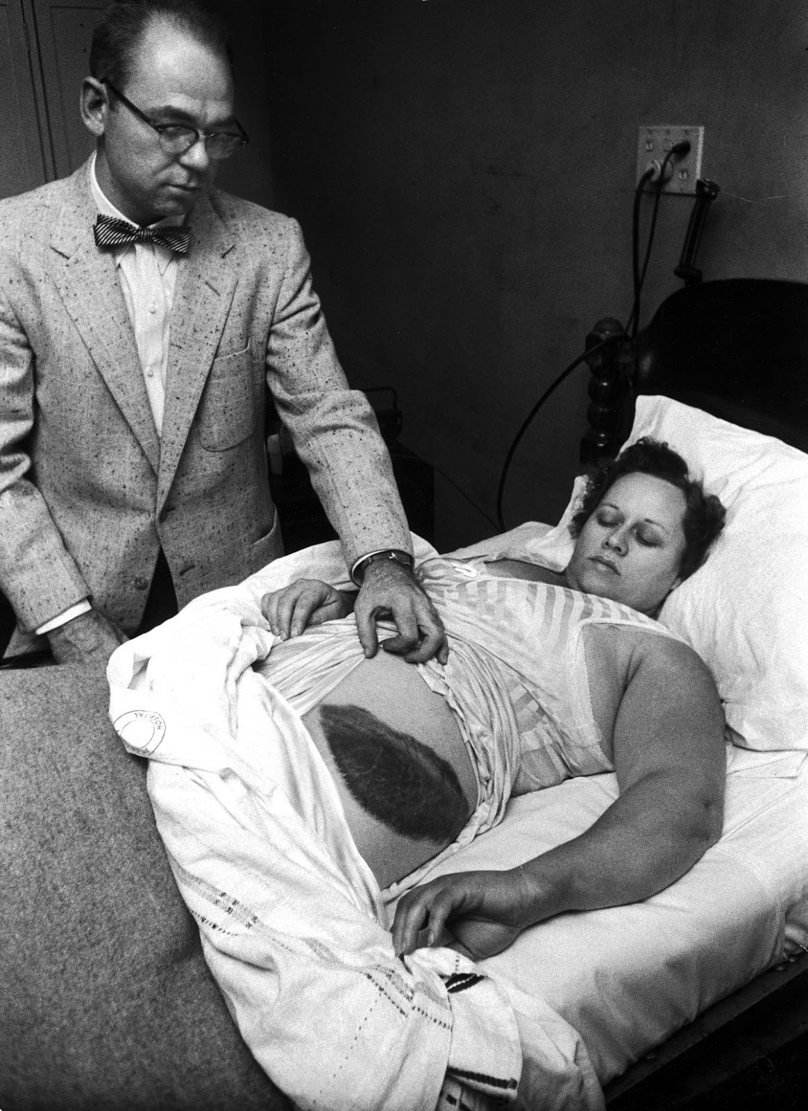 Moody Jacobs shows a giant bruise on the side and hip of his patient, Ann Hodges, in 1954, after she was struck by a meteorite.