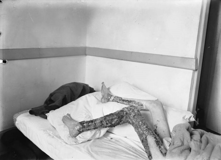 The badly burned legs of a young child caught in the fire.