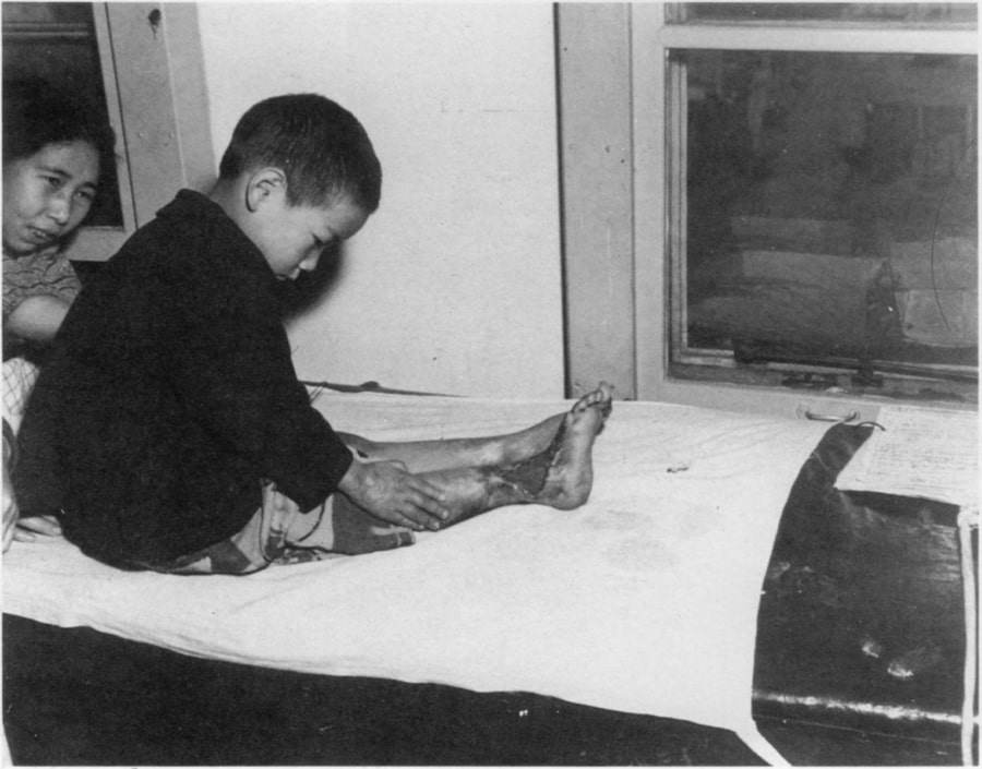 A three-year-old boy burned by the napalm firebombs of a subsequent strike in May 1945. Germany had surrendered but Japan battled on. Tokyo, Japan.