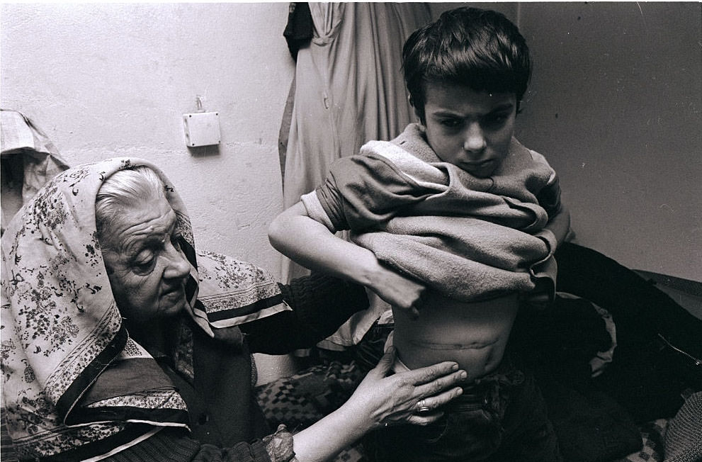 Mirza Mangajic, a 10-year-old Muslim boy, survives in Sarajevo's Old Town quarter with his grandmother, showing a scar on his belly he received from a grenade explosion.
