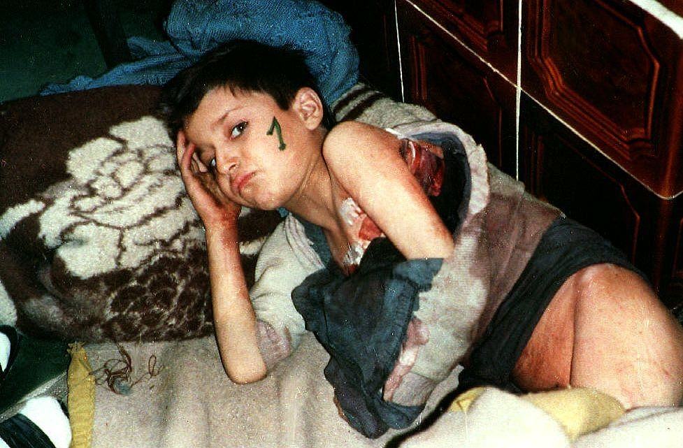 A poorly nourished and wounded Bosnian child lies on a makeshift hospital bed waiting for his evacuation from Srebrenica, 1993.