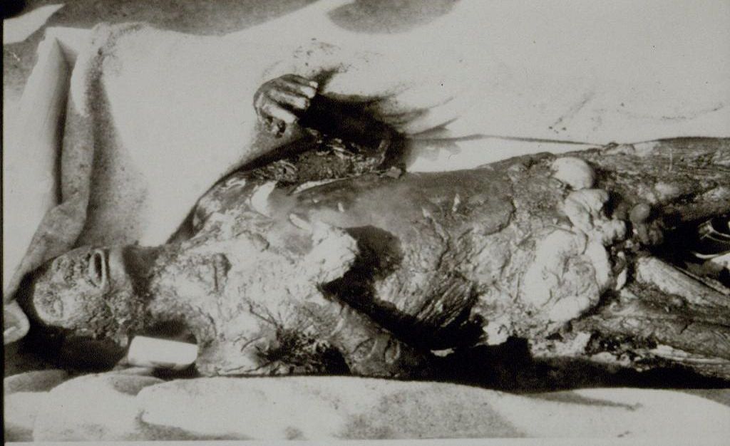 A burnt body of a victim of Bosnian Genocide, 1992.